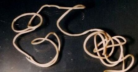 Guinea's worm